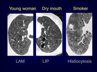 Young woman

LAM

Dry mouth

LIP

Smoker

Histiocytosis

 