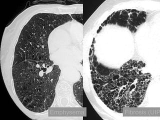 Emphysema

Fibrosis (UIP

 