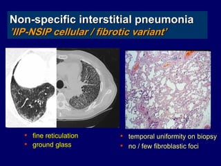 Non-specific interstitial pneumonia
’IIP-NSIP cellular / fibrotic variant’

• fine reticulation
• ground glass

• temporal uniformity on biopsy
• no / few fibroblastic foci

 