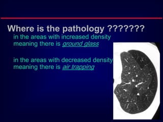 Where is the pathology ???????
in the areas with increased density
meaning there is ground glass
in the areas with decreased density
meaning there is air trapping

 