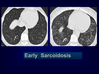 Early Sarcoidosis

 