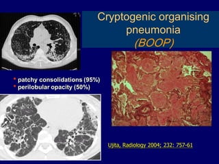 Cryptogenic organising
pneumonia

(BOOP)
• patchy consolidations (95%)
• perilobular opacity (50%)

Ujita, Radiology 2004; 232: 757-61

 