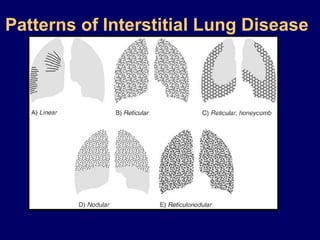Patterns of Interstitial Lung Disease

 