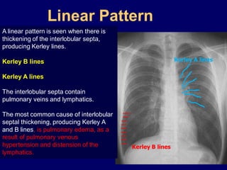 Linear Pattern
A linear pattern is seen when there is
thickening of the interlobular septa,
producing Kerley lines.
Kerley A lines

Kerley B lines
Kerley A lines
The interlobular septa contain
pulmonary veins and lymphatics.
The most common cause of interlobular
septal thickening, producing Kerley A
and B lines, is pulmonary edema, as a
result of pulmonary venous
hypertension and distension of the
lymphatics.

Kerley B lines

 