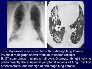 This 50-year-old man presented with end-stage lung fibrosis
PA chest radiograph shows medium to coarse reticular
B: CT scan shows multiple small cysts (honeycombing) involving
predominantly the subpleural peripheral regions of lung. Traction
bronchiectasis, another sign of end-stage lung fibrosis.

 
