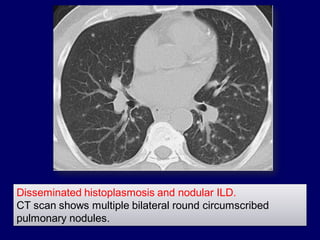 Disseminated histoplasmosis and nodular ILD.
CT scan shows multiple bilateral round circumscribed
pulmonary nodules.

 