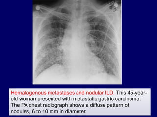 Hematogenous metastases and nodular ILD. This 45-yearold woman presented with metastatic gastric carcinoma.
The PA chest radiograph shows a diffuse pattern of
nodules, 6 to 10 mm in diameter.

 