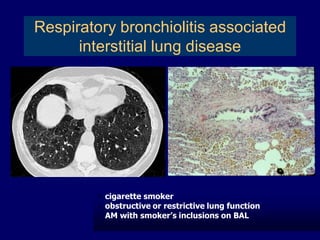 Respiratory bronchiolitis associated
interstitial lung disease

cigarette smoker
 obstructive or restrictive lung function
 AM with smoker’s inclusions on BAL


 