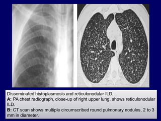 Disseminated histoplasmosis and reticulonodular ILD.
A: PA chest radiograph, close-up of right upper lung, shows reticulonodular
ILD.
B: CT scan shows multiple circumscribed round pulmonary nodules, 2 to 3
mm in diameter.

 