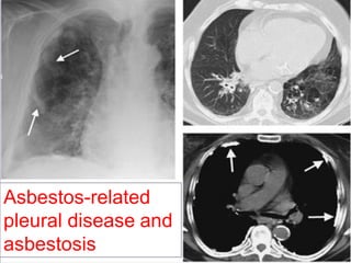 Asbestos-related
pleural disease and
asbestosis

 