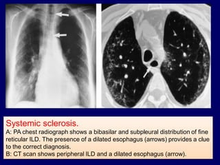 Systemic sclerosis.
A: PA chest radiograph shows a bibasilar and subpleural distribution of fine
reticular ILD. The presence of a dilated esophagus (arrows) provides a clue
to the correct diagnosis.
B: CT scan shows peripheral ILD and a dilated esophagus (arrow).

 