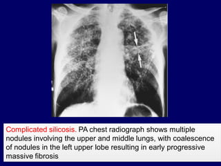 Complicated silicosis. PA chest radiograph shows multiple
nodules involving the upper and middle lungs, with coalescence
of nodules in the left upper lobe resulting in early progressive
massive fibrosis

 
