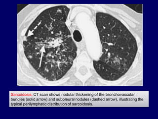 Sarcoidosis. CT scan shows nodular thickening of the bronchovascular
bundles (solid arrow) and subpleural nodules (dashed arrow), illustrating the
typical perilymphatic distribution of sarcoidosis.

 