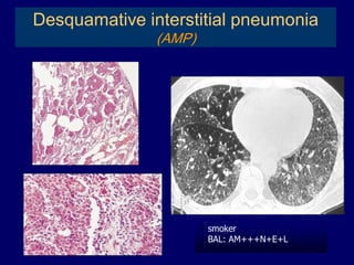 Desquamative interstitial pneumonia
(AMP)




smoker
BAL: AM+++N+E+L

 