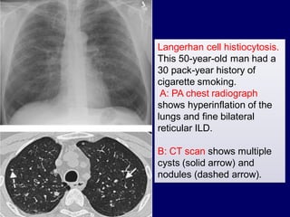 Langerhan cell histiocytosis.
This 50-year-old man had a
30 pack-year history of
cigarette smoking.
A: PA chest radiograph
shows hyperinflation of the
lungs and fine bilateral
reticular ILD.
B: CT scan shows multiple
cysts (solid arrow) and
nodules (dashed arrow).

 