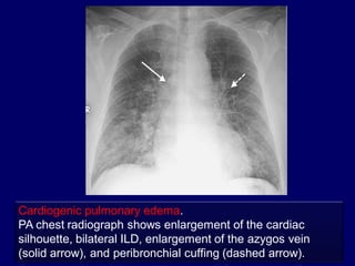Cardiogenic pulmonary edema.
PA chest radiograph shows enlargement of the cardiac
silhouette, bilateral ILD, enlargement of the azygos vein
(solid arrow), and peribronchial cuffing (dashed arrow).

 