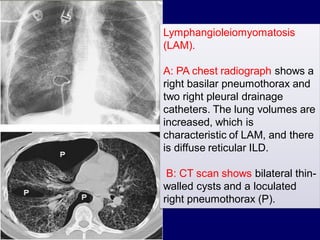Lymphangioleiomyomatosis
(LAM).

A: PA chest radiograph shows a
right basilar pneumothorax and
two right pleural drainage
catheters. The lung volumes are
increased, which is
characteristic of LAM, and there
is diffuse reticular ILD.
B: CT scan shows bilateral thinwalled cysts and a loculated
right pneumothorax (P).

 