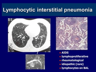 LIP
Lymphocytic interstitial pneumonia

AIDS
 lymphoproliferative
 rheumatological
 idiopathic (rare)
 lymphocytes on BAL


 
