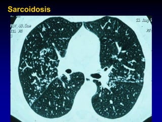 Sarcoidosis

 