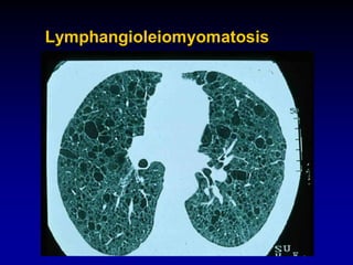 Lymphangioleiomyomatosis

 