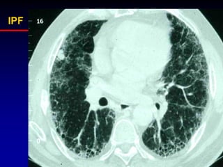 IPF

 