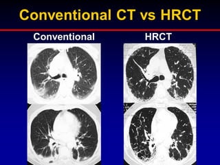 Conventional CT vs HRCT
Conventional
CT

HRCT

 