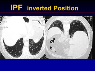 IPF

inverted Position

 