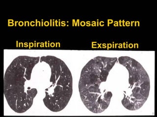 Bronchiolitis: Mosaic Pattern
Inspiration

Exspiration

 