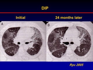 DIP
Initial

24 months later

Ryu 2005

 