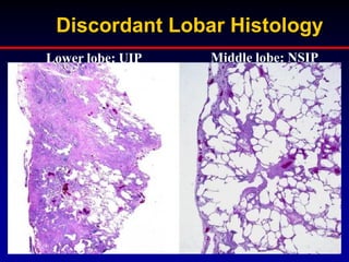 Discordant Lobar Histology
Lower lobe: UIP

Middle lobe: NSIP

 