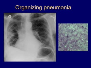 Organizing pneumonia

 