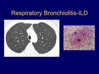 Respiratory Bronchiolitis-ILD

 