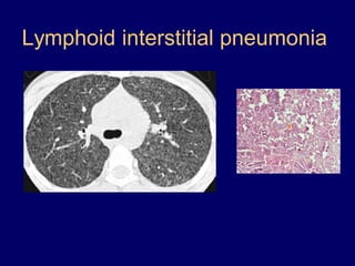 Lymphoid interstitial pneumonia

 