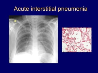 Acute interstitial pneumonia

 