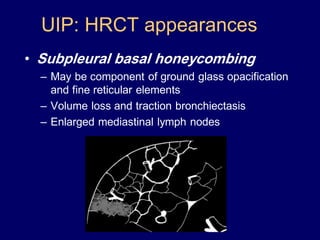 UIP: HRCT appearances
• Subpleural basal honeycombing
– May be component of ground glass opacification
and fine reticular elements
– Volume loss and traction bronchiectasis
– Enlarged mediastinal lymph nodes

 