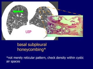 UIP

basal subpleural
honeycombing*
*not merely reticular pattern, check density within cystic
air spaces

 