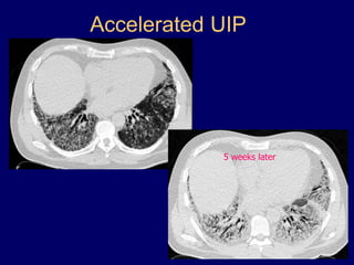 Accelerated UIP

5 weeks later

 
