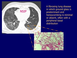 NSIP

A fibrosing lung disease
in which ground glass is
predominant and
honeycombing is minimal
or absent, often with a
peripheral basal
distribution

 