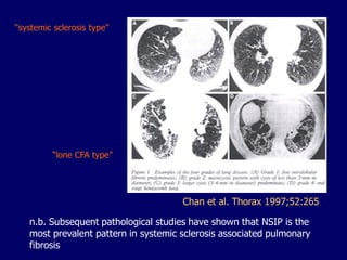 “systemic sclerosis type”

“lone CFA type”

Chan et al. Thorax 1997;52:265
n.b. Subsequent pathological studies have shown that NSIP is the
most prevalent pattern in systemic sclerosis associated pulmonary
fibrosis

 