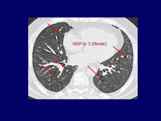 NSIP Gr 3 (fibrotic)

 