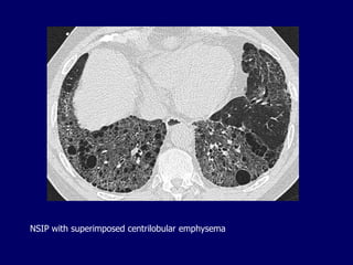 NSIP with superimposed centrilobular emphysema

 