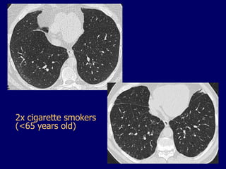 2x cigarette smokers
(<65 years old)

 