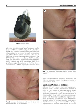 D.T. Alexandrescu and E.V. Ross

92

Figure 1 Roller RF device.

where the patient reports a “warm” sensation. Another
laser uses 870 nm and 930 nm light.33 They found that
after 4- and 2-minute exposures (in the same ofﬁce visit)
which were carried out 4 times at roughly monthly intervals, 75% of the nail cultures had cleared. They used infrared (IR) thermometers to maintain temperature (T) at
102°F (39°C) at a laser power density of 1 W/cm2. Other
lasers have been applied, but no published peer-reviewed
studies compare laser with conventional medical approaches. One popular system is the PinPointe laser, a
device that uses 1064 nm to gently heat the nails. In the

Figure 3 (A) Pretreatment RF pixel acne scar. (B) 3 months after 1
treatment.

future, expect to see other light-based technologies that
inactivate fungus and bacteria through photothermal or
photochemical means.

Combining Medications and Laser

Figure 2 Patient just after treatment with roller RF device—note
microwounds about 200 ␮m in diameter.

Nelson et al34 have examined the role of angiogenesisinhibiting drugs. They noted that PDL is the treatment of
choice for PWS, but that in many cases, lesions remain
resistant to laser treatment. They theorized that low therapeutic efﬁcacy might be caused by revascularization of
photocoagulated blood vessels owing to angiogenesis associated with the normal wound-healing response. Rapamycin, an inhibitor of mammalian target of rapamycin,
effectively inhibits the growth of pathologic blood vessels.
They developed a transgenic mouse model of pathologic
angiogenesis with inducible overexpression of activated

 