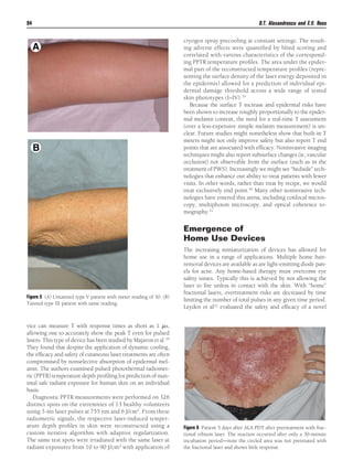 94

D.T. Alexandrescu and E.V. Ross
cryogen spray precooling at constant settings. The resulting adverse effects were quantiﬁed by blind scoring and
correlated with various characteristics of the corresponding PPTR temperature proﬁles. The area under the epidermal part of the reconstructed temperature proﬁles (representing the surface density of the laser energy deposited in
the epidermis) allowed for a prediction of individual epidermal damage threshold across a wide range of tested
skin phototypes (I–IV).39
Because the surface T increase and epidermal risks have
been shown to increase roughly proportionally to the epidermal melanin content, the need for a real-time T assessment
(over a less-expensive simple melanin measurement) is unclear. Future studies might nonetheless show that built-in T
meters might not only improve safety but also report T end
points that are associated with efﬁcacy. Noninvasive imaging
techniques might also report subsurface changes (ie, vascular
occlusion) not observable from the surface (such as in the
treatment of PWS). Increasingly we might see “bedside” technologies that enhance our ability to treat patients with fewer
visits. In other words, rather than treat by recipe, we would
treat exclusively end point.40 Many other noninvasive technologies have entered this arena, including confocal microscopy, multiphoton microscopy, and optical coherence tomography.41

Emergence of
Home Use Devices

Figure 5 (A) Untanned type V patient with meter reading of 30. (B)
Tanned type III patient with same reading.

vice can measure T with response times as short as 1 ␮s,
allowing one to accurately show the peak T even for pulsed
lasers. This type of device has been studied by Majaron et al.38
They found that despite the application of dynamic cooling,
the efﬁcacy and safety of cutaneous laser treatments are often
compromised by nonselective absorption of epidermal melanin. The authors examined pulsed photothermal radiometric (PPTR) temperature depth proﬁling for prediction of maximal safe radiant exposure for human skin on an individual
basis.
Diagnostic PPTR measurements were performed on 326
distinct spots on the extremities of 13 healthy volunteers
using 3-ms laser pulses at 755 nm and 6 J/cm2. From these
radiometric signals, the respective laser-induced temperature depth proﬁles in skin were reconstructed using a
custom iterative algorithm with adaptive regularization.
The same test spots were irradiated with the same laser at
radiant exposures from 10 to 90 J/cm2 with application of

The increasing miniaturization of devices has allowed for
home use in a range of applications. Multiple home hairremoval devices are available as are light-emitting diode panels for acne. Any home-based therapy must overcome eye
safety issues. Typically this is achieved by not allowing the
laser to ﬁre unless in contact with the skin. With “home”
fractional lasers, overtreatment risks are decreased by time
limiting the number of total pulses in any given time period.
Leyden et al42 evaluated the safety and efﬁcacy of a novel

Figure 6 Patient 5 days after ALA PDT after pretreatment with fractional erbium laser. The reaction occurred after only a 30-minute
incubation period—note the circled area was not pretreated with
the fractional laser and shows little response.

 