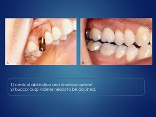1) cervical abfraction and recession present
2) buccal cusp inclines needs to be adjusted.
 