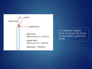A 12-degree angled
force increases the force
to the implant system by
18.6%.
 