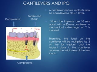 CANTILEVERS AND IPO
 A cantilever on two implants may
be considered a class 1 lever.
 When the implants are 10 mm
apart, with a 20-mm cantilever, a
mechanical advantage of 2 is
created.
 Therefore, the load on the
cantilever will be multiplied by 2
on the far implant, and the
implant close to the cantilever
receives the total stress of the two
loads.
Compressive
Tensile and
shear
Compressive
 