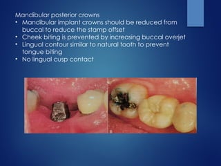 Mandibular posterior crowns
• Mandibular implant crowns should be reduced from
buccal to reduce the stamp offset
• Cheek biting is prevented by increasing buccal overjet
• Lingual contour similar to natural tooth to prevent
tongue biting
• No lingual cusp contact
 