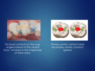 Primary centric contact (red)
Secondary centric contacts
(green)
Occlusal contacts on the cusp
angles instead of the central
fossa. Increase in the magnitude
of shear stress.
 