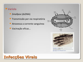 Varíola

    Smallpox (dsDNA)

    Transmissão por via respiratória

    Atravessa a corrente sanguínea

    Vacinação eficaz…




Infecções Virais
 